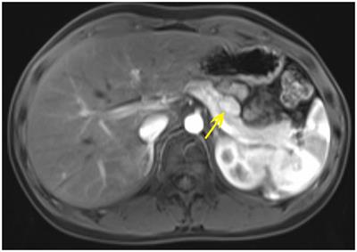 Case report: Novel germline c.587delA pathogenic variant in familial multiple endocrine neoplasia type 1